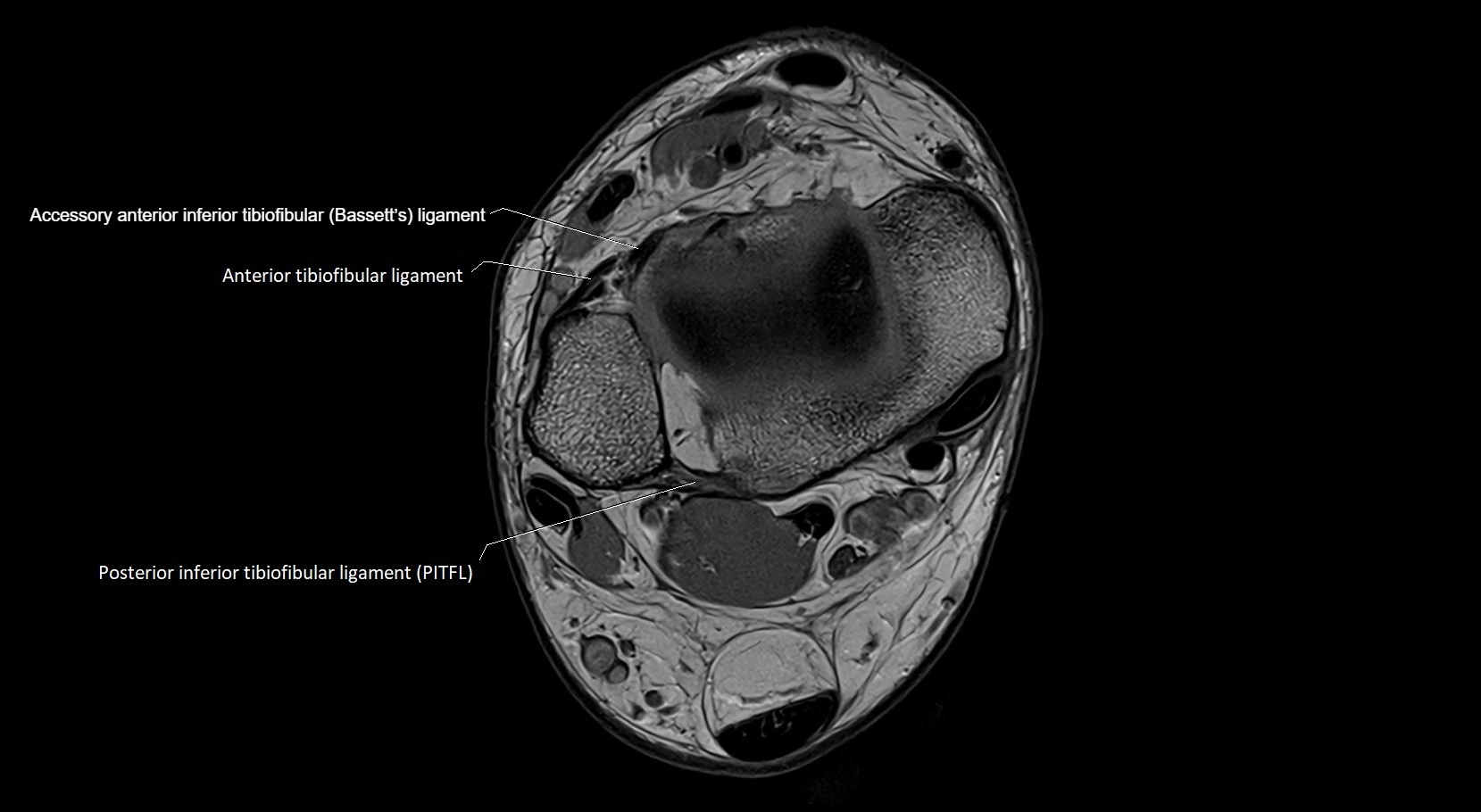 MRI ankle ligaments anatomy axial 3T image 3.webp